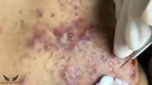 Blackhead Whitehead Removal - Cystic Acne Treatment - Elderly Pimple Popping - Facial Acne Spa |#08