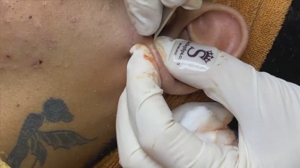 Увлекательное выдавливание прыщей за ушами #прыщи #угри