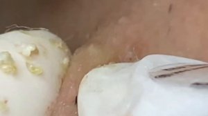 Выдавливание прыщей, угрей, черных точек и камедонов #48