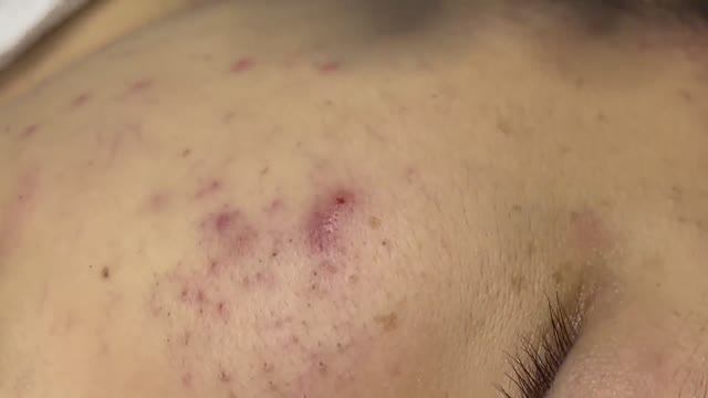 Механическая чистка от воспаленных прыщей #121 смотреть онлайн