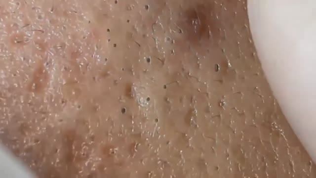 Asmr. Удаление подкожных угрей, комедонов 90400 смотреть онлайн