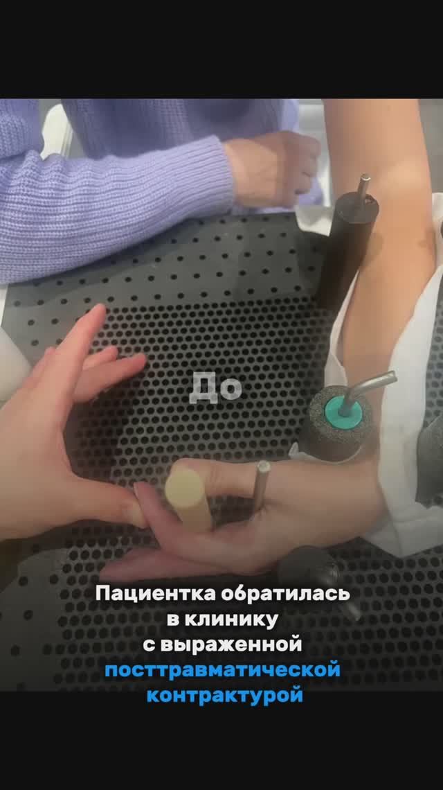 🤏 Устранение контрактуры после перелома фаланги пальца