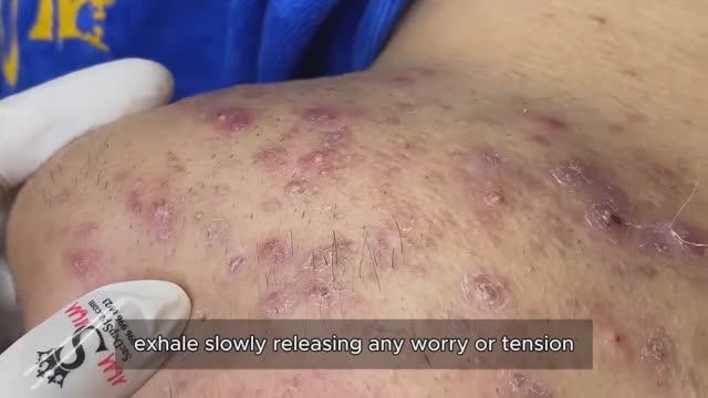 Профессиональное удаление комедонов на носу и подбородке #90329 смотреть онлайн