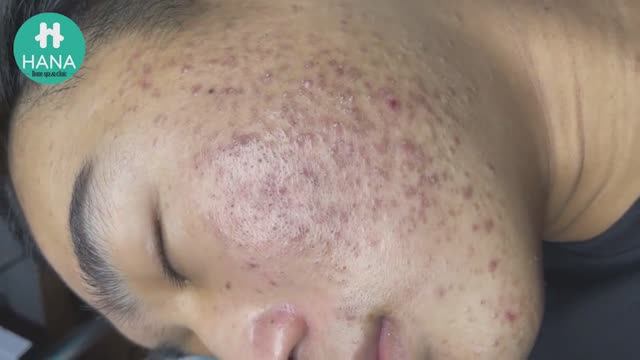 Профессиональное очищение от угрей и сальных пробок. Asmr. #1 смотреть онлайн