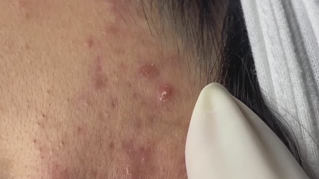 Избавляемся от прыщей и восстанавливаем кожный барьер #124 #чисткалица #прыщи смотреть онлайн