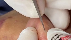 Выдавливание прыщей, угрей, черных точек и камедонов #53