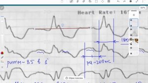 ПБ ЛНПГ и нижний ИМ