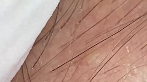 Выдавливание прыщей, угрей, черных точек и камедонов #54