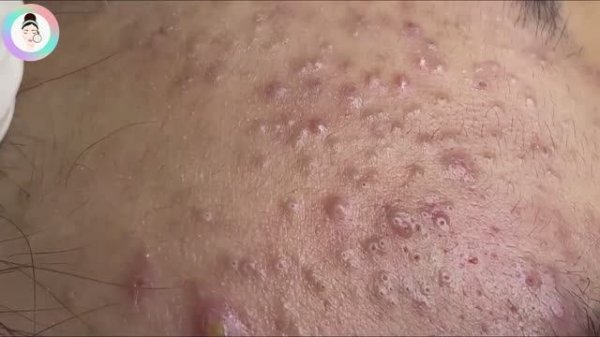 Выдавливание и удаление прыщей — приятного просмотра!