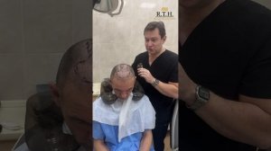 Год после пересадки волос. Результат и решение об уплотнении!