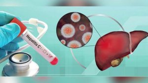 Будьте здоровы. Гепатит С