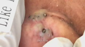 Расслабляющее видео: удаление акне и черных точек за ухом