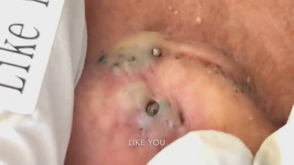 Расслабляющее видео: удаление акне и черных точек за ухом