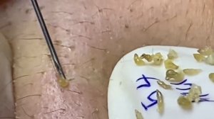 Выдавливание прыщей, угрей, черных точек и камедонов #57