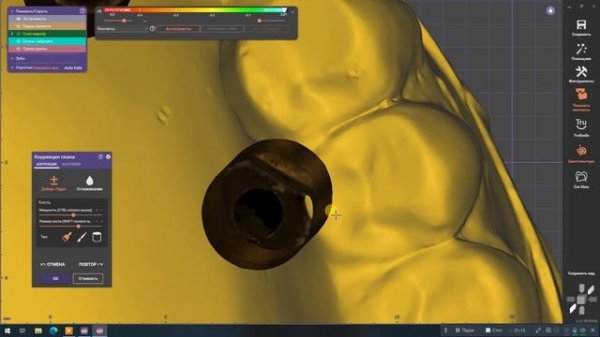 Гипсовка в ExoCad - полное руководство