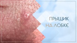 🙁 Прыщик на лобке. Клинический случай №61