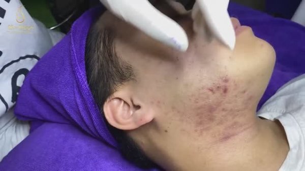 Подкожные прыщи и белые угри: самая неприятная проблема (154)