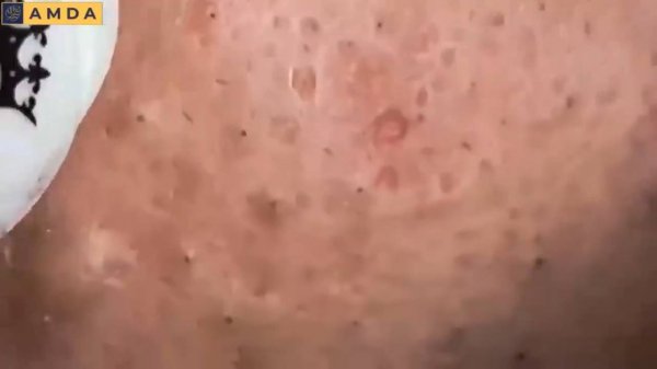 Удаление стойких комедонов в салоне красоты #2169