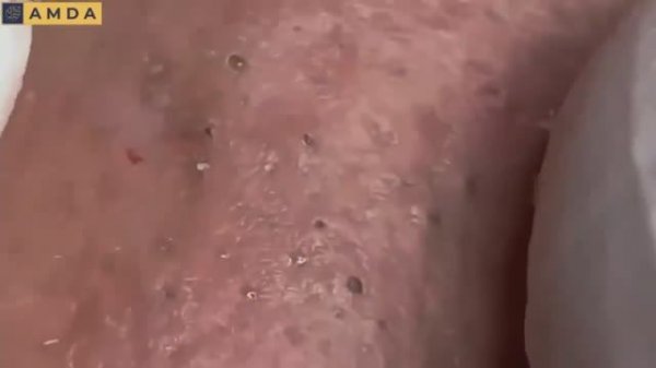 Механическая чистка кожи от прыщей и сальных пробок.#2175