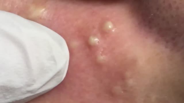 Полное удаление акне: чистка лица у специалиста смотреть онлайн