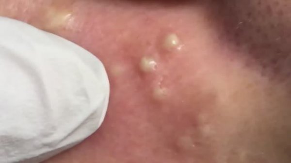 Полное удаление акне: чистка лица у специалиста