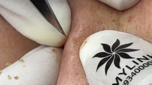 Процедура лечения угревой сыпи #06