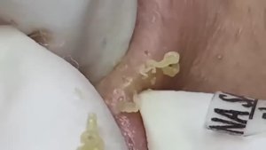 Лечение подкожных угрей. Asmr 2164