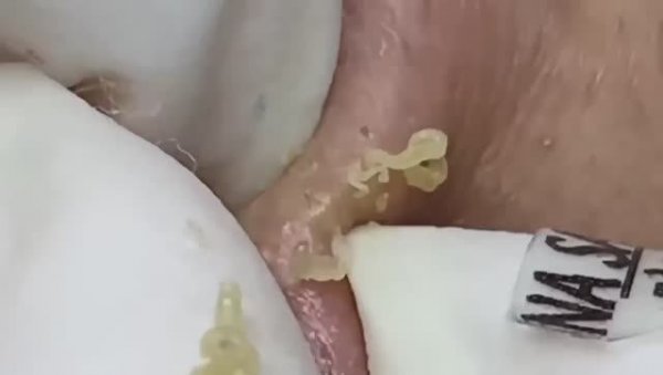 Лечение подкожных угрей. Asmr 2164