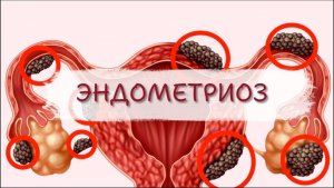 ЭНДОМЕТРИОЗ. ВЗГЛЯД ИЗ АСТРАЛА