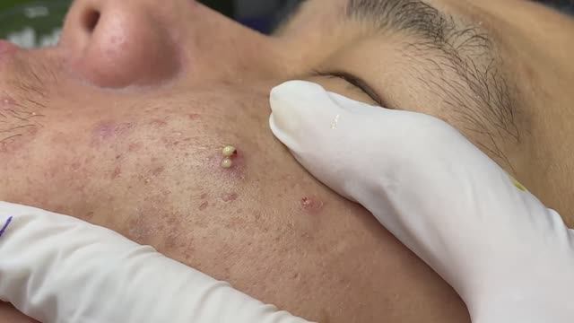 Проблемные прыщи, которые не исчезают самостоятельно смотреть онлайн