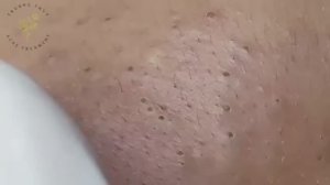 Чистка кожи от прыщей и черных точек: комплексный подход. 5124