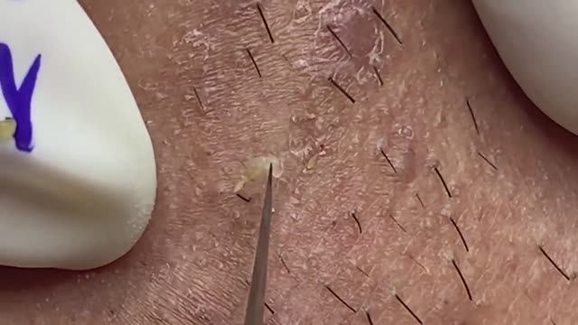 Механическое очищение от черных точек. #132 Asmr смотреть онлайн