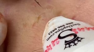 Выдавливание прыщей, угрей, черных точек и камедонов #61