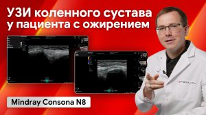 УЗИ коленного сустава у пациента с ожирением на Mindray Consona N8