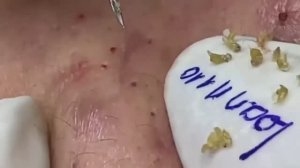 Удаление от комедонов и сальных пробок. Asmr 2166