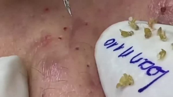 Удаление от комедонов и сальных пробок. Asmr 2166