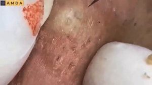 Глубокая чистка кожи от комедонов: результаты. 2150