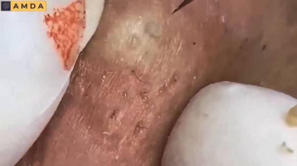 Глубокая чистка кожи от комедонов: результаты. 2150