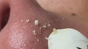 Чистим комедоны и прыщи на носу