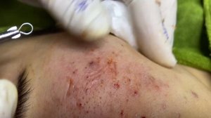 Лечение акне у пациентки Нгок #чисткалица  #прыщи #угри