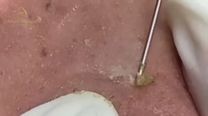 Чистим лицо от акне и угревой сыпи. Asmr 2162