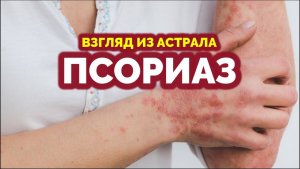ПСОРИАЗ. ВЗГЛЯД ИЗ АСТРАЛА