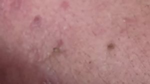 Выдавливание прыщей, угрей, черных точек и камедонов #62