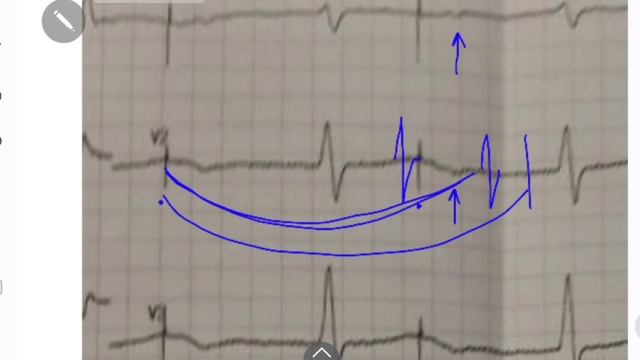 ЭКГ с непонятными стимулами смотреть онлайн