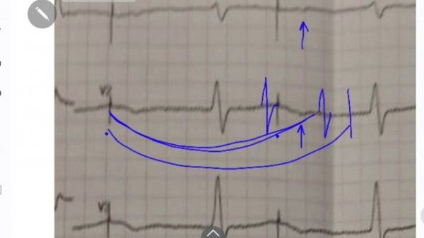 ЭКГ с непонятными стимулами