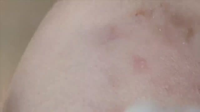 Подкожные прыщи и воспаления на подбородке - SDS#131 смотреть онлайн