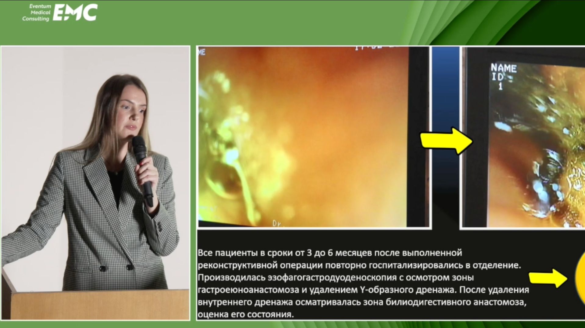 3 ЛазареваАС Вакурова ЕС ЭРХПГ у пациентов с измененной анатомией после операции на желчн протоках