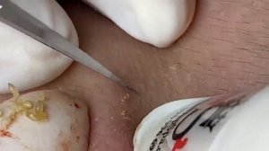 Выдавливание прыщей, угрей, черных точек и камедонов #69