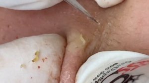 Выдавливание прыщей, угрей, черных точек и камедонов #65