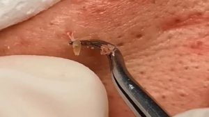 #90 Чистка лица от угрей и акне. Выдавливание прыщей. Удаление черных точек и комедонов